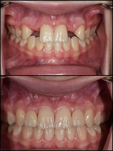 Dental Implants Restore Your Smile And Confidence