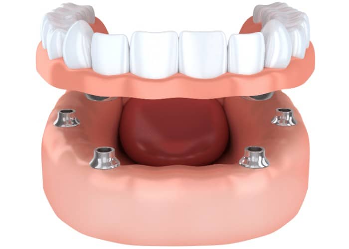Dental Implants vs Dentures: How to choose the right option?