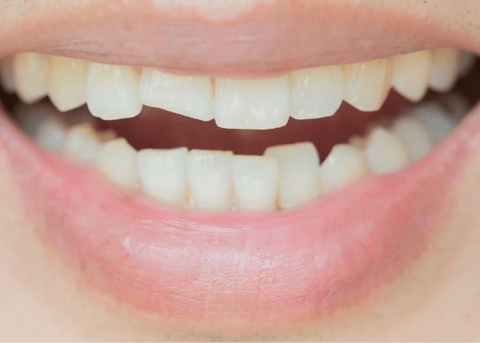 Can Edge Bonding fix my uneven teeth?