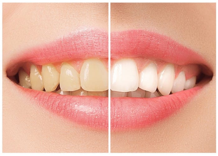 Teeth Staining: What causes it and how to avoid the staining cycle?