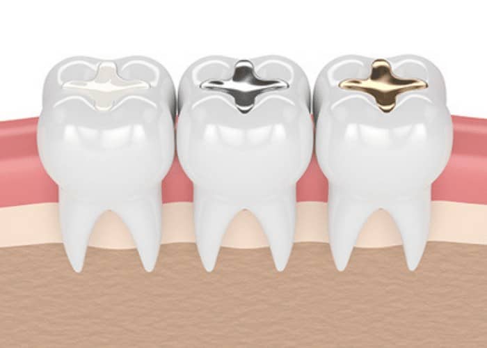 7 common questions about dental fillings answered