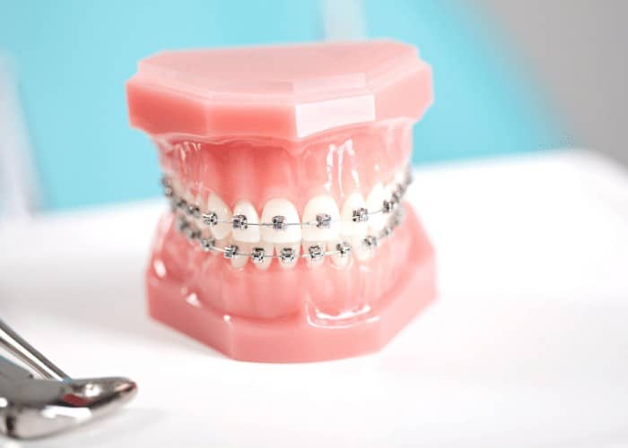 Are Metal Braces a thing of the past?