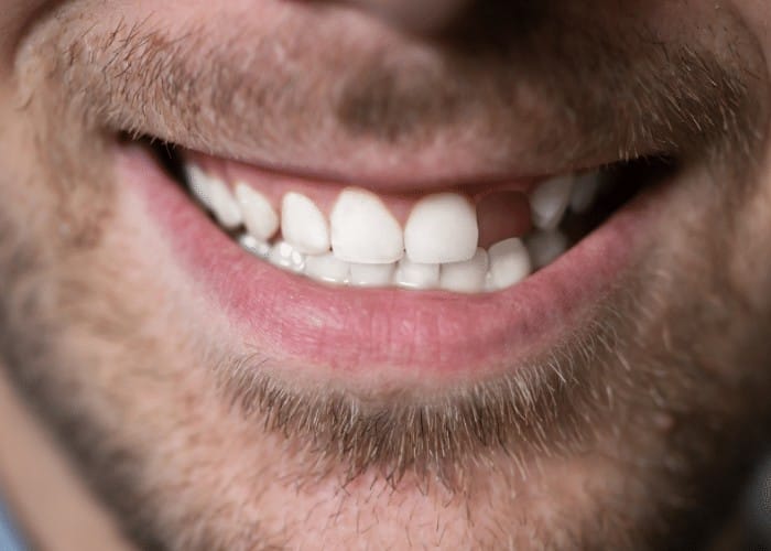 Missing Teeth. 5 tooth replacement options to consider