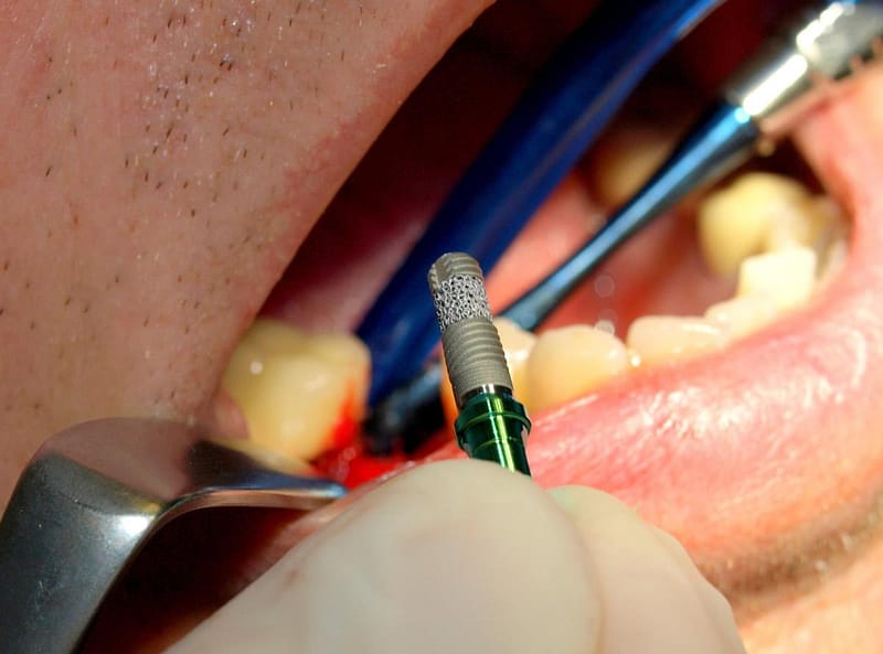 Trabecular Dental Implants