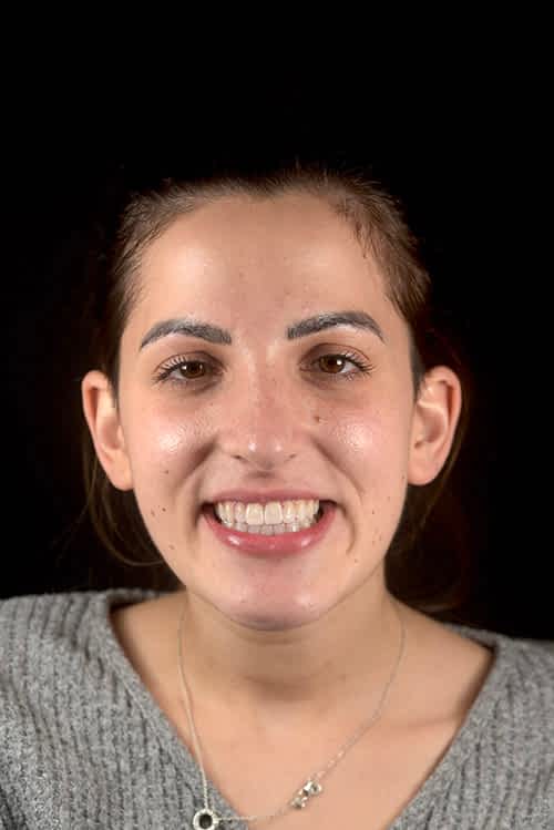 Composite Bonding Banning Dental Group