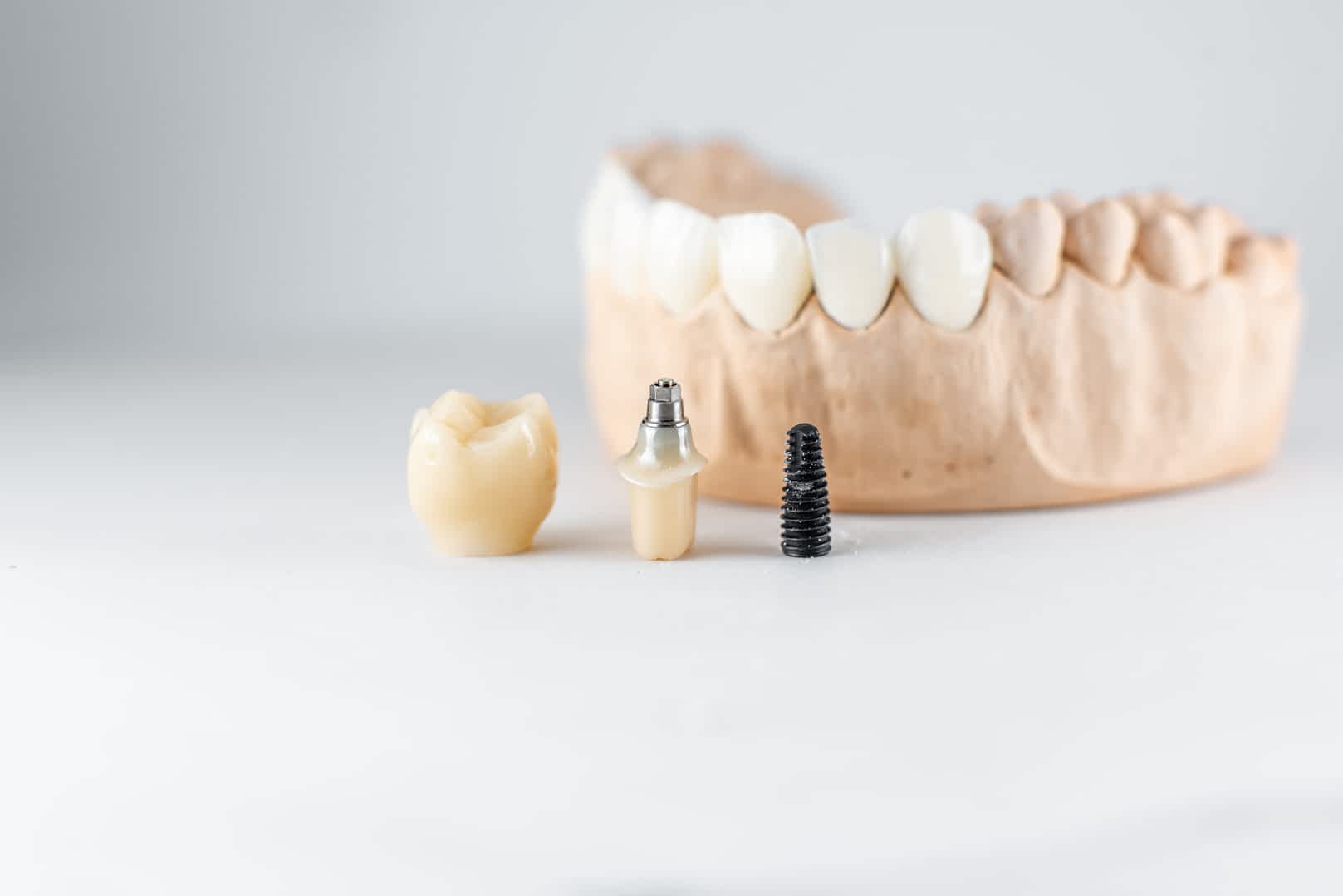Discover the Benefits of Dental Crowns and Implants in London 1 dental-crowns-and-implants