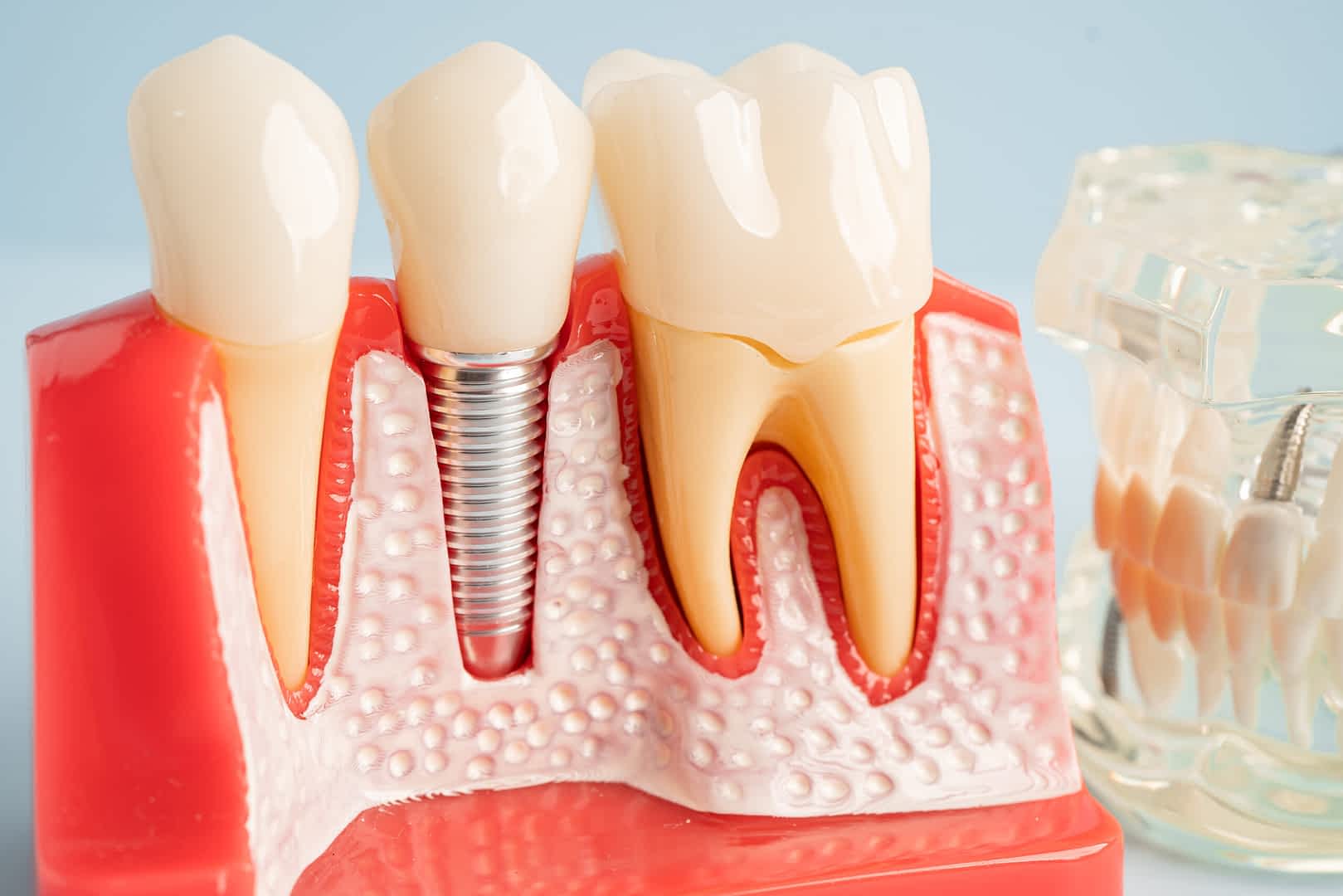 implant-dentists