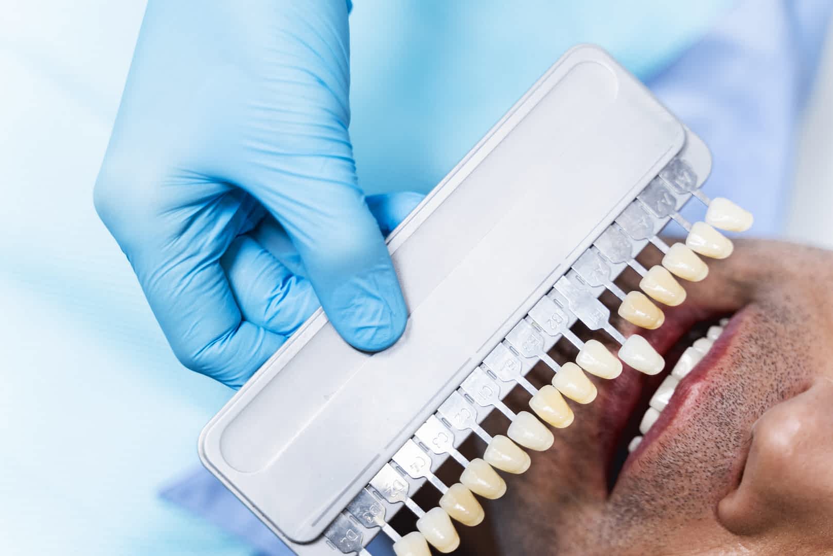 teeth-whitening-canning-town