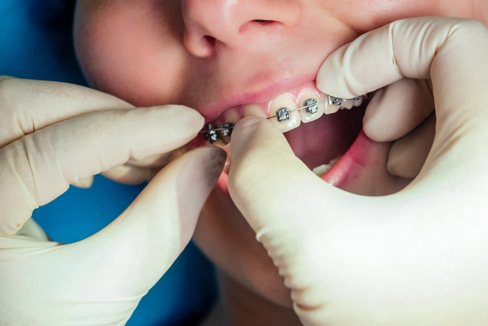 Orthodontics Crawley: Achieve Your Dream Smile Today! 1 orthodontics-crawley