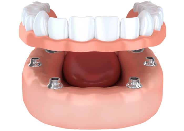 dental implants vs dentures