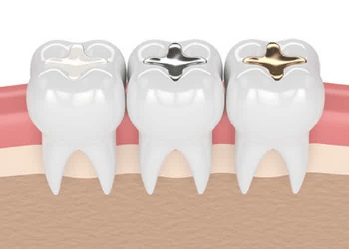 Dental fillings
