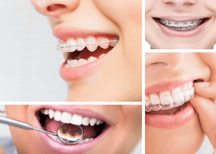 dental braces