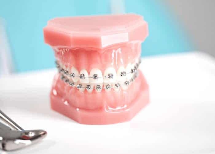 Are Metal Braces a thing of the past? 1 Metal Braces