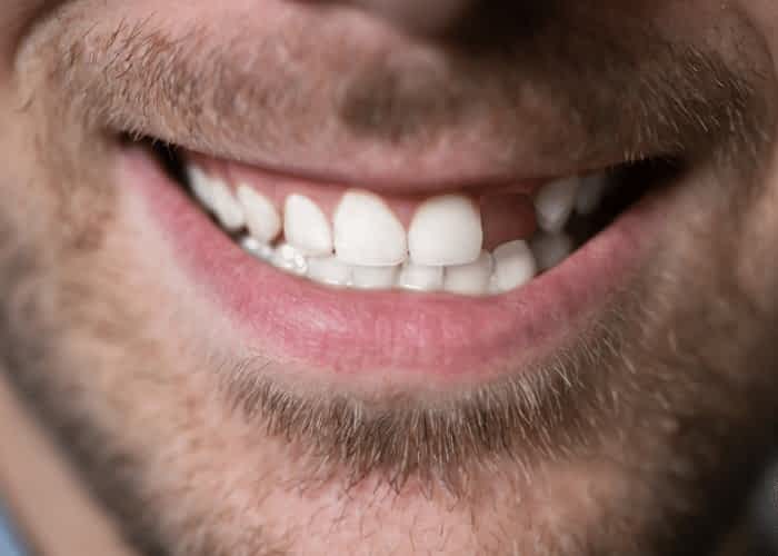 Missing Teeth