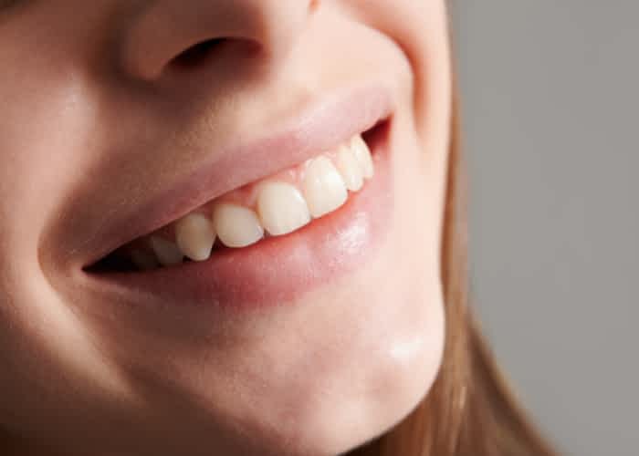Straight Smile