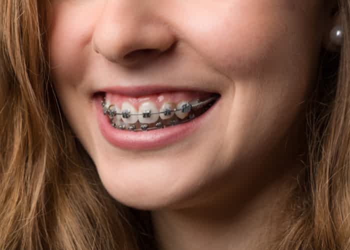Orthodontic Care