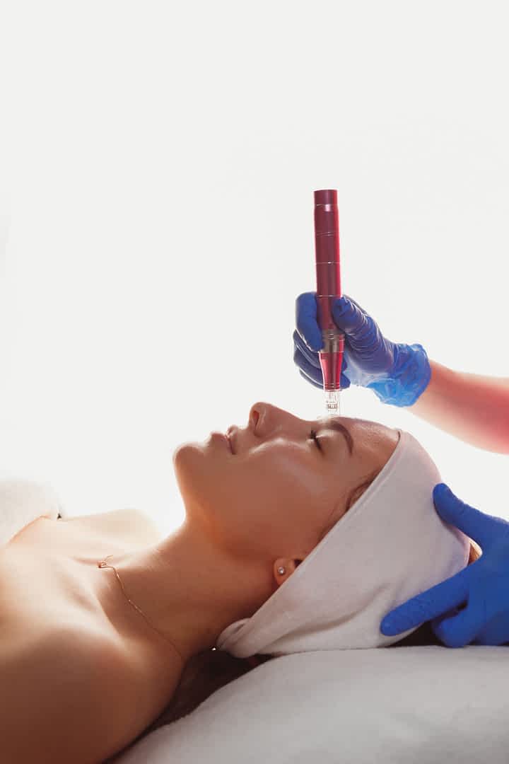 microneedling-with- exosomes