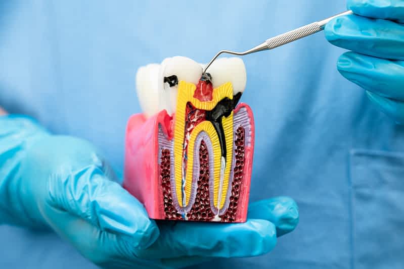 Root Canal Retreatment: Essential Insights for Lasting Dental Health 1 root-canal-retreatment