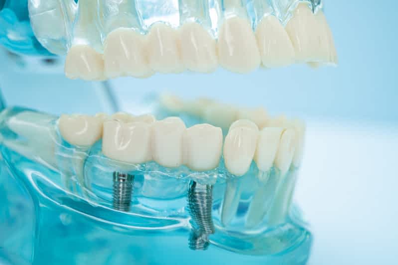 dental-implants-crawley