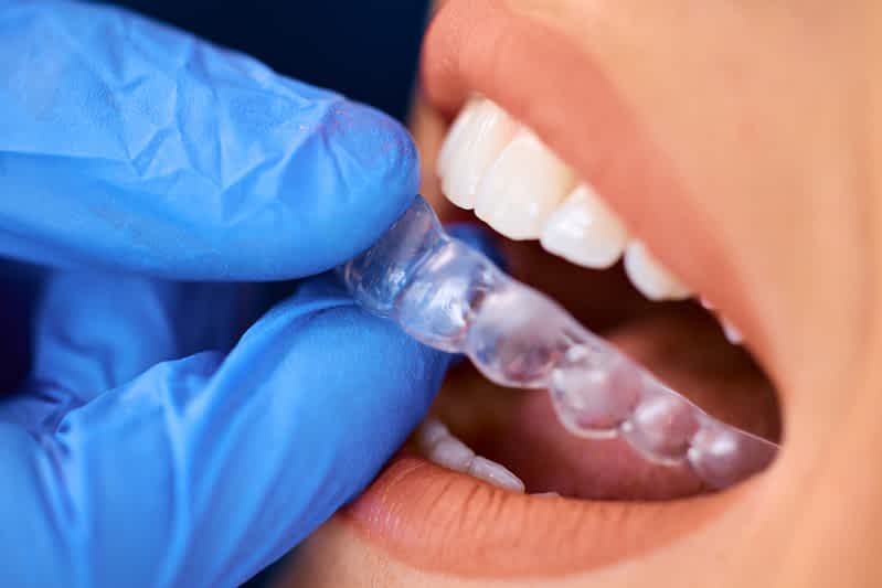 invisalign-kent