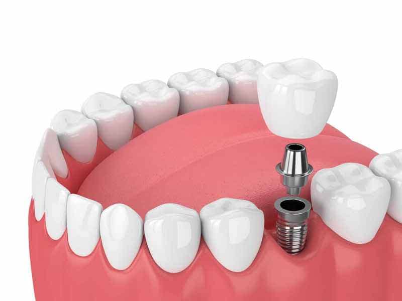 dental tooth implants in london