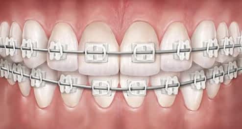 clear braces
