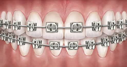 metal braces